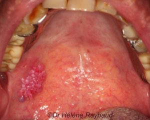 papillomavirus sous la langue