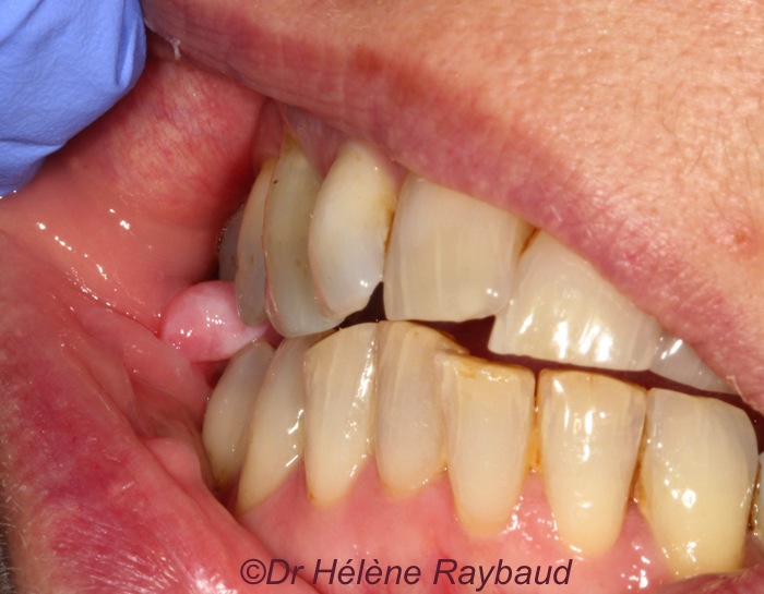 Diapneusie Dermatologie buccale