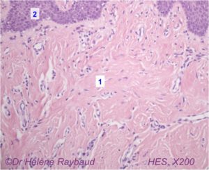 Epulis fissuratum Histologie