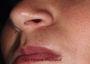 Kyste naso-labial – Dermatologie buccale