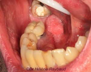 Papillomavirus verrue bouche