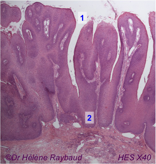 Papillome buccal / Condylome acuminé / Verrue vulgaire Dermatologie buccale