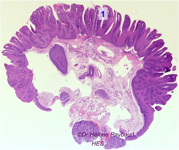 Papillome buccal / Condylome acuminé / Verrue vulgaire Dermatologie buccale