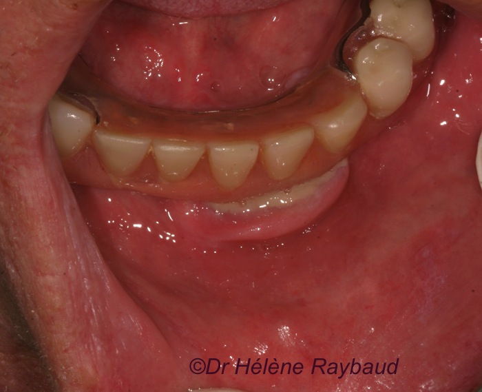 Epulis fissuratum / fissurée Dermatologie buccale