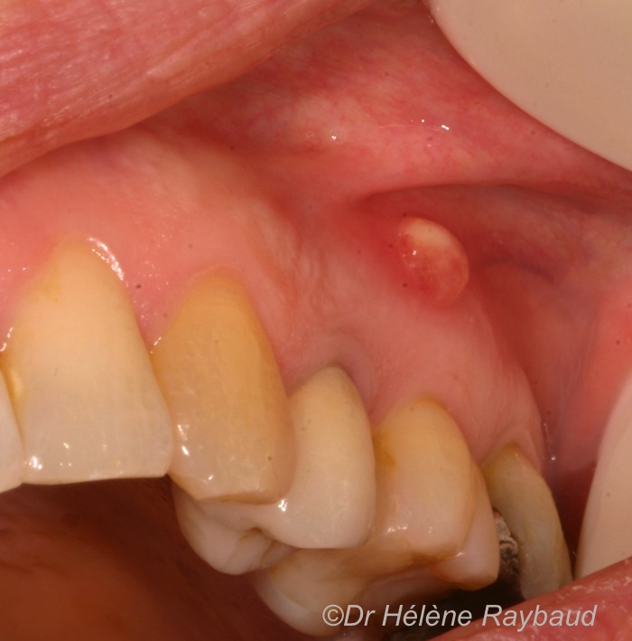 Abcès apical et parodontal / Fistule dentaire / Granulome fistulisé Dermatologie buccale