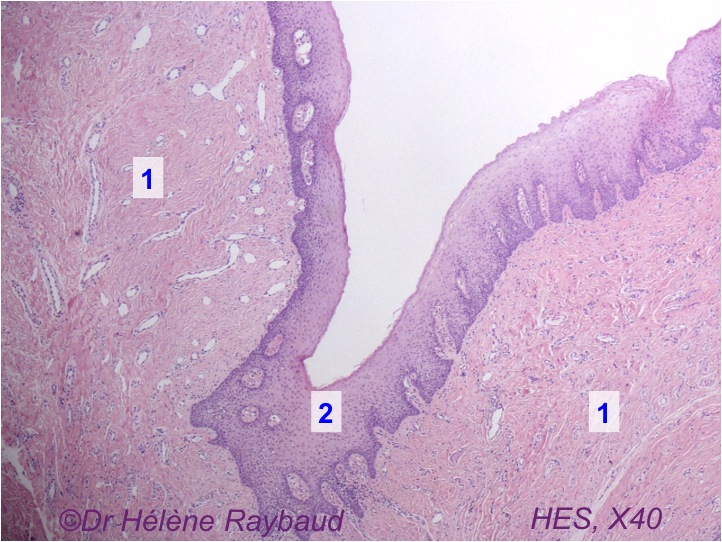 Epulis fissuratum / fissurée – Dermatologie buccale