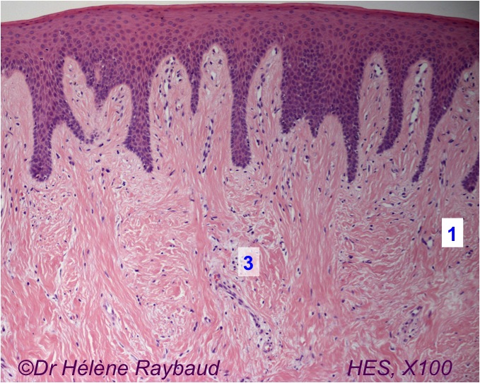 Epulis inflammatoire – Epulis fibreuse +/- ossifiante – Dermatologie ...