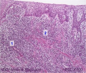 Epulis inflammatoire – Epulis fibreuse +/- ossifiante – Dermatologie ...